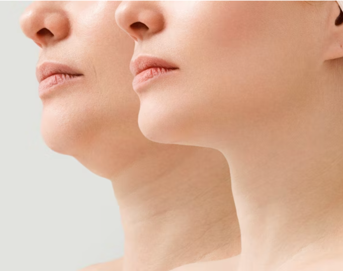 Everesse Non-Invasive Skin Tightening and Lifting (2 Treatment Package)